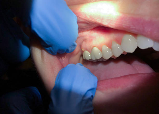 Best Emergency Treatment for Dental Infections or Abscesses in Addison, TX